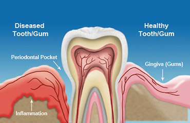Illustration of gum disease